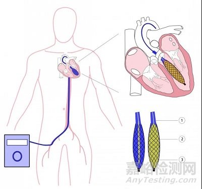 CardiacBooster Device：流量最大的心脏泵