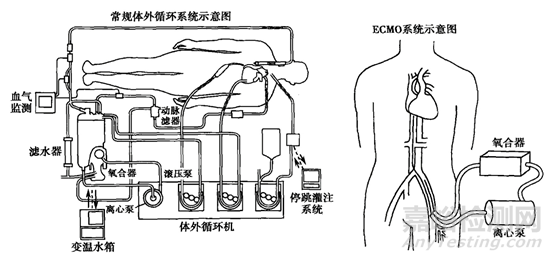 国产ECMO整体研发取得阶段性进展