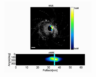 I3 NIRF-IVUS：近红外光谱和超声二合一血管造影导管
