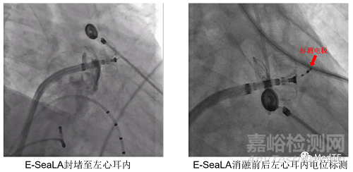 E-SeaLA：全球首创具有PFA消融功能的左心耳封堵器