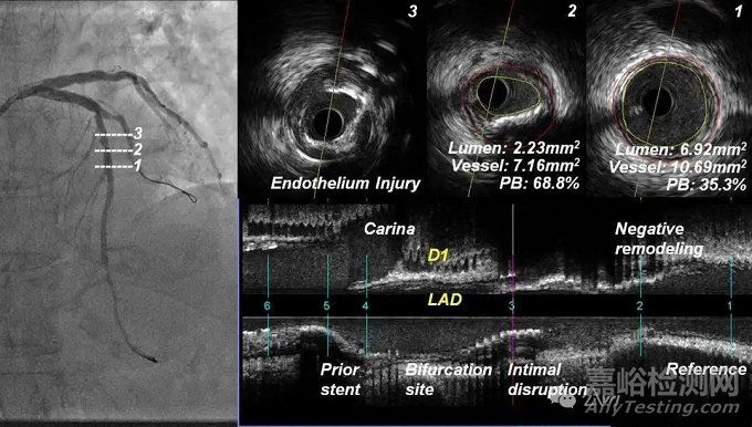 血管内超声（IVUS）设计原理、装配结构、和成像常见问题分析