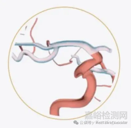 国产首款新型涂层血流导向密网支架技术解析