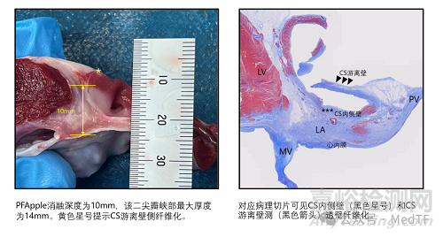 全球首款球囊形大局灶PFA导管启动多中心临床