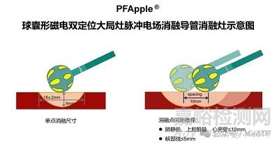 全球首款球囊形大局灶PFA导管启动多中心临床