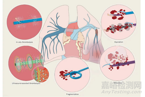 Aventus机械性血栓切除系统获批FDA，可治疗肺栓塞（PE）