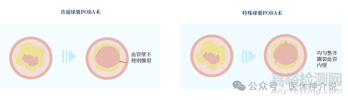 血管介入特殊球囊技术解析