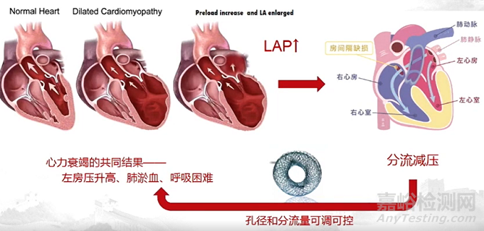 【创新医械】全球首款心房分流器