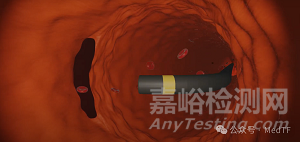 【创新医械】AX-GEN01：生物可吸收主动脉夹层修补补片，实现血管壁再生