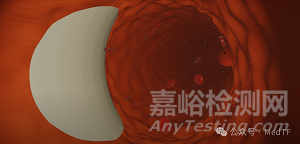 【创新医械】AX-GEN01：生物可吸收主动脉夹层修补补片，实现血管壁再生