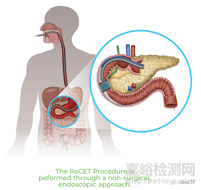 【创新医械】ReCET：电脉冲消融治疗糖尿病，不仅能改善血糖，而能改善体重和血脂