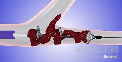 英纳瑞创新医械 “肺动脉取栓系统”技术解析