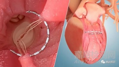 AccuCinch：首款经皮修复心室治疗心衰器械完成第一阶段临床入组