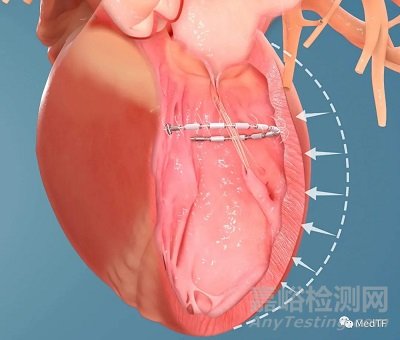 AccuCinch：首款经皮修复心室治疗心衰器械完成第一阶段临床入组