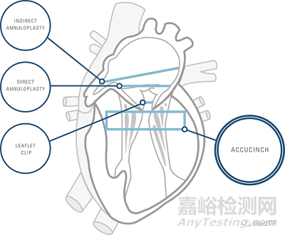 AccuCinch：首款经皮修复心室治疗心衰器械完成第一阶段临床入组