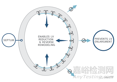 AccuCinch：首款经皮修复心室治疗心衰器械完成第一阶段临床入组