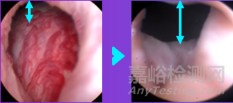 Rezūm：FDA批准波科蒸汽消融新适应症