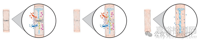 VersaWrap：首款固液双形态肌腱修复水凝胶