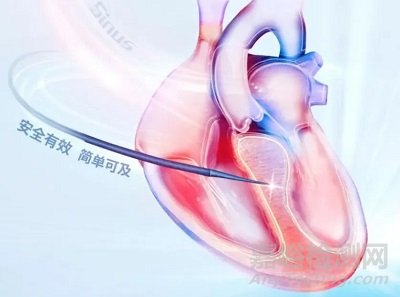赛纳思医疗创新经导管室间隔心肌内射频消融系统技术解析
