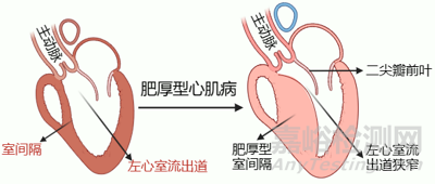 赛纳思医疗创新经导管室间隔心肌内射频消融系统技术解析