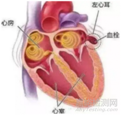 国产首款V型左心耳闭合系统获批上市
