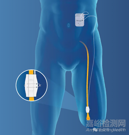 Altius：治疗慢性截肢后幻肢疼痛和残肢疼痛的神经刺激产品