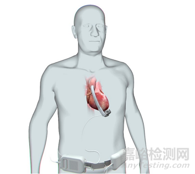 【创新医械】基于独特波浪膜技术的左心室辅助装置