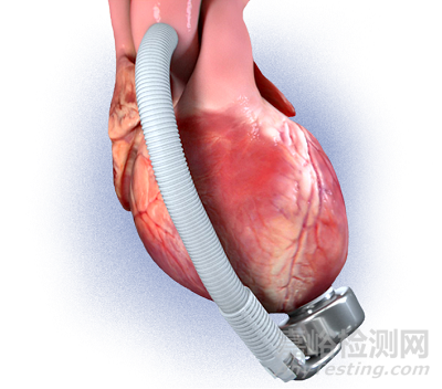 【创新医械】基于独特波浪膜技术的左心室辅助装置
