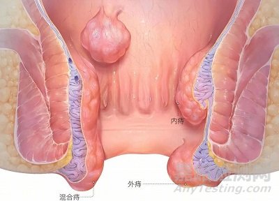 施爱德创新医械一次性带可吸收钉电动痔吻合器技术解析