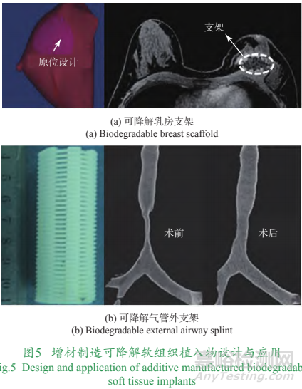 增材制造个性化植入物技术发展与挑战