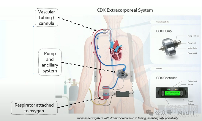 【创新医械】CDX：仅8斤重的可穿戴ECMO