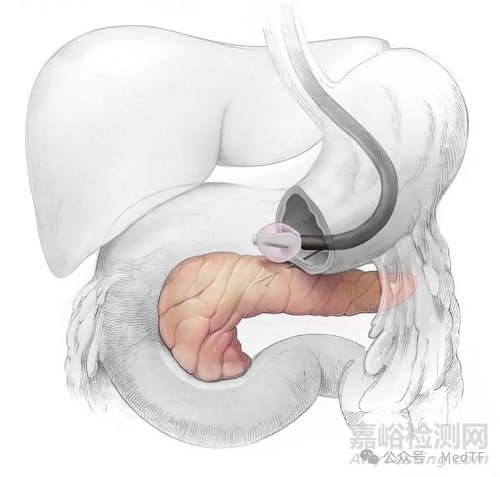 【创新医械】REJUVA：胰腺基因疗法治疗T2D