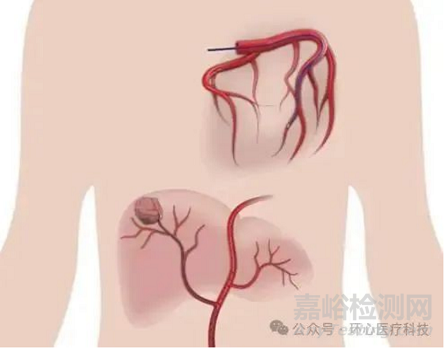 国产首款可控弯微导管获批上市