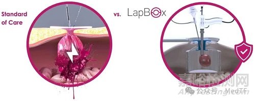 【创新医械】LapBox POWER ：肿瘤组织粉碎保护器