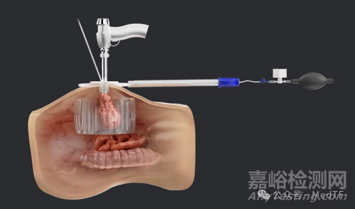 【创新医械】LapBox POWER ：肿瘤组织粉碎保护器